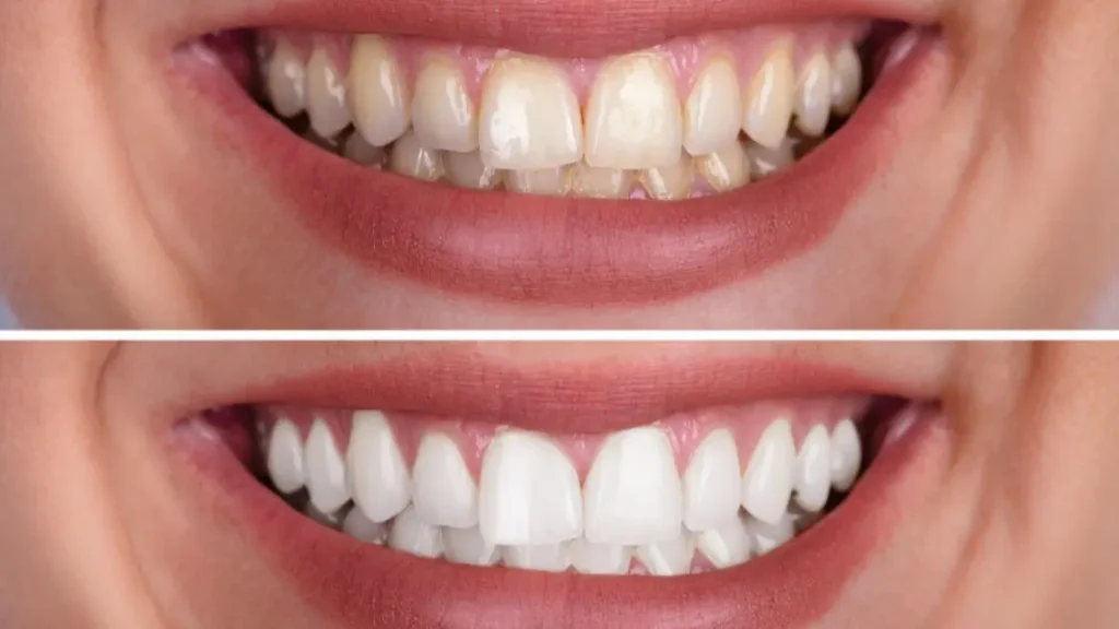 Lente de contato dental aplicada, proporcionando um sorriso natural